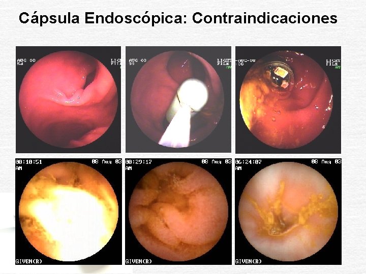 Cápsula Endoscópica: Contraindicaciones 