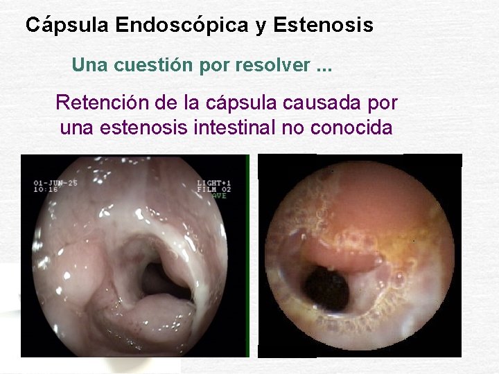 Cápsula Endoscópica y Estenosis Una cuestión por resolver. . . Retención de la cápsula