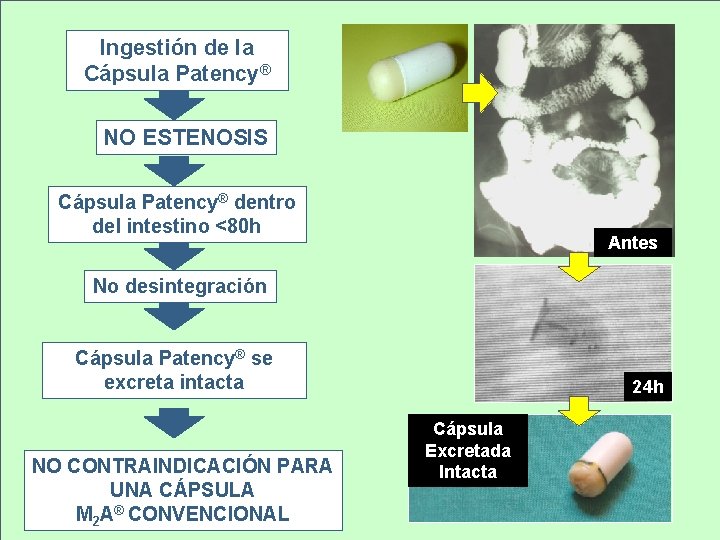 Ingestión de la Cápsula Patency® NO ESTENOSIS Cápsula Patency® dentro del intestino <80 h