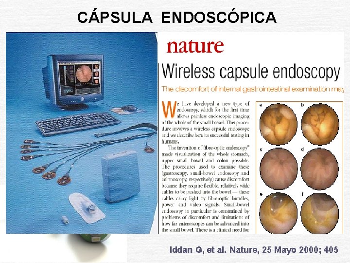 CÁPSULA ENDOSCÓPICA Iddan G, et al. Nature, 25 Mayo 2000; 405 