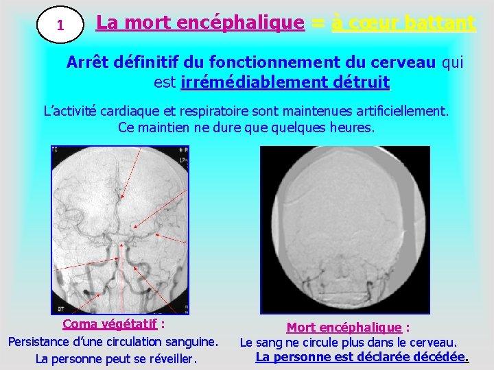 1 La mort encéphalique = à cœur battant Arrêt définitif du fonctionnement du cerveau