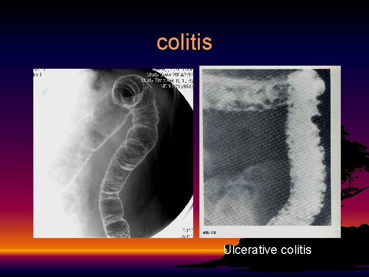 colitis Ulcerative colitis 