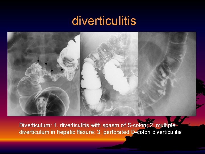 diverticulitis Diverticulum: 1. diverticulitis with spasm of S-colon; 2. multiple diverticulum in hepatic flexure;