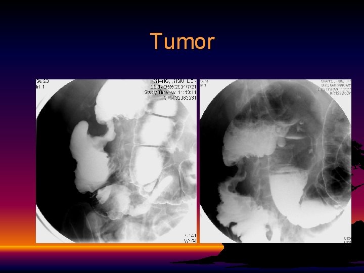 Tumor 