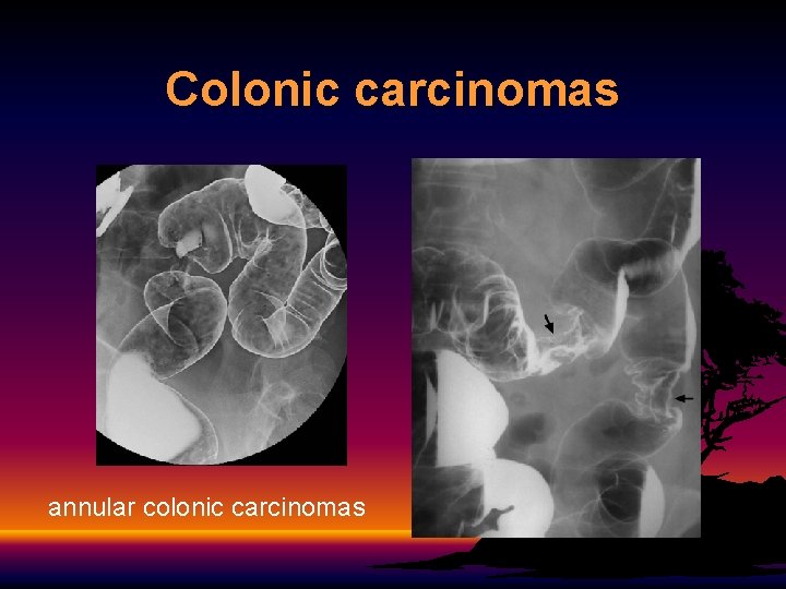 Colonic carcinomas annular colonic carcinomas 