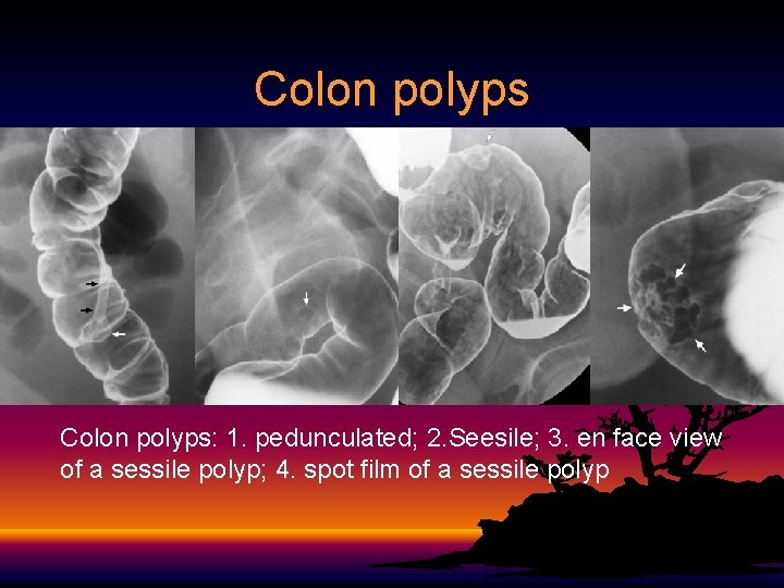 Colon polyps: 1. pedunculated; 2. Seesile; 3. en face view of a sessile polyp;