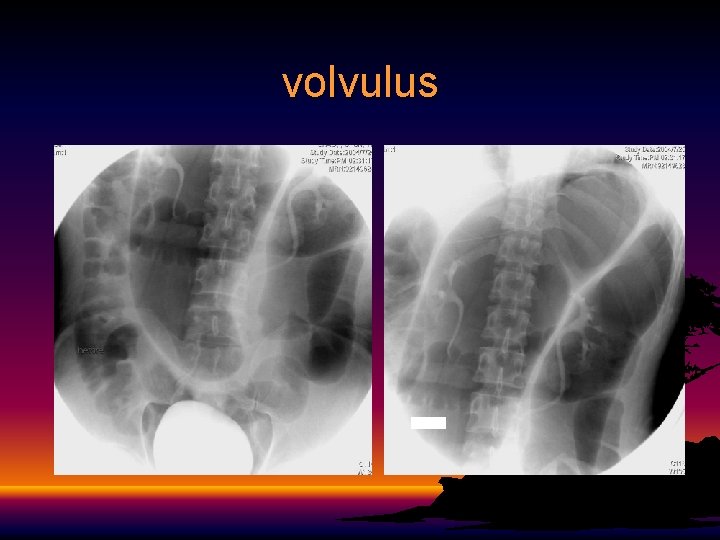 volvulus 