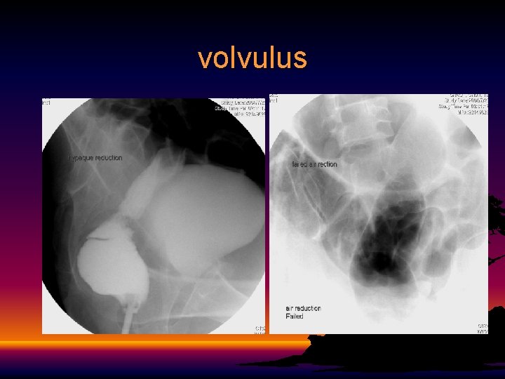 volvulus 