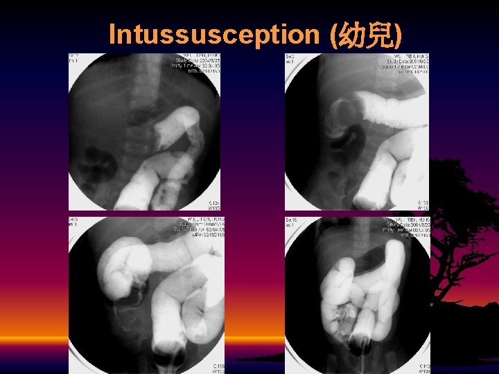 Intussusception (幼兒) 