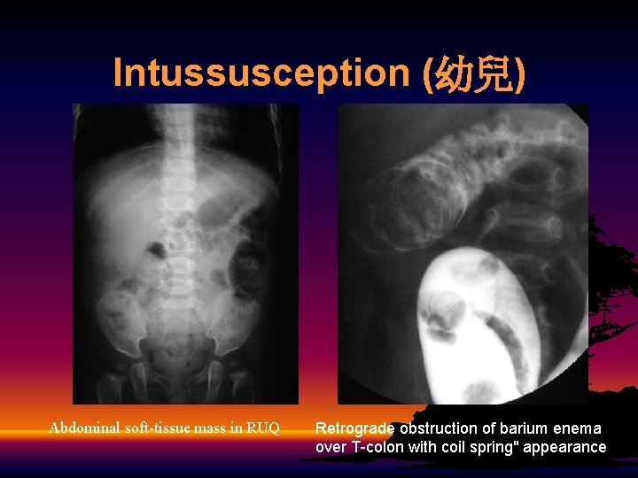 Intussusception (幼兒) Abdominal soft-tissue mass in RUQ Retrograde obstruction of barium enema over T-colon