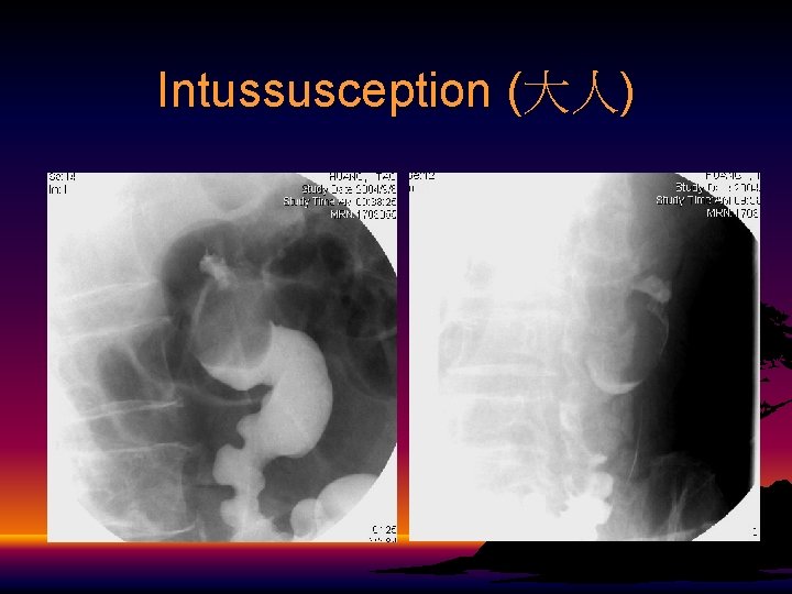 Intussusception (大人) 