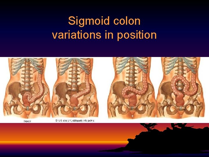 Sigmoid colon variations in position 