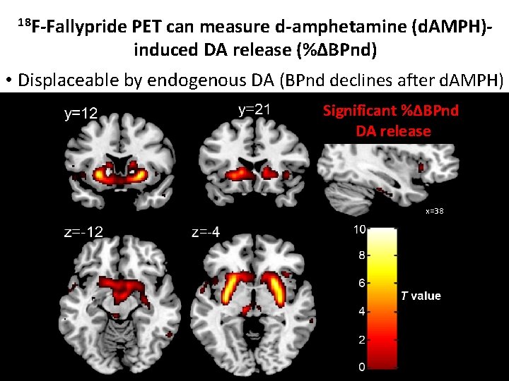 18 F-Fallypride PET can measure d-amphetamine (d. AMPH)- induced DA release (%ΔBPnd) • Displaceable 18 F-Fallypride PET can measure d-amphetamine (d. AMPH)- induced DA release (%ΔBPnd) • Displaceable
