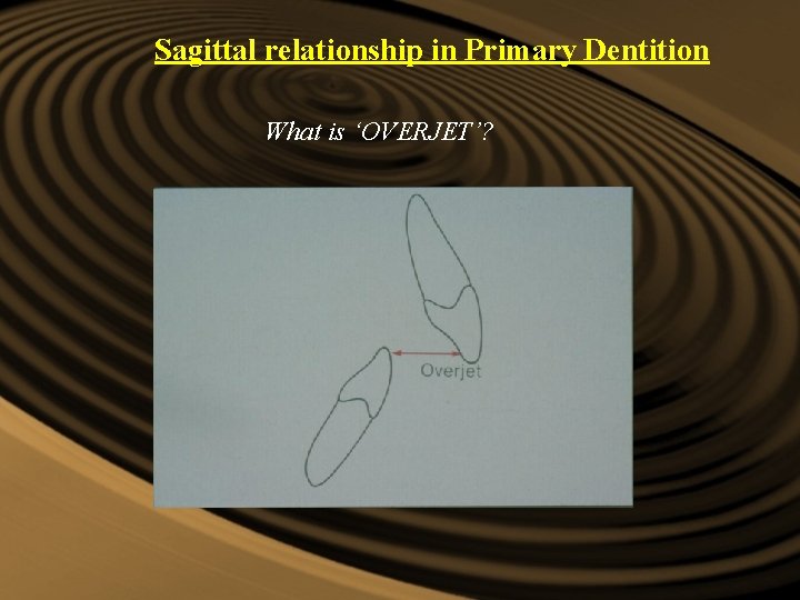 Sagittal relationship in Primary Dentition What is ‘OVERJET’? Sagittal relationship in Primary Dentition What is ‘OVERJET’?