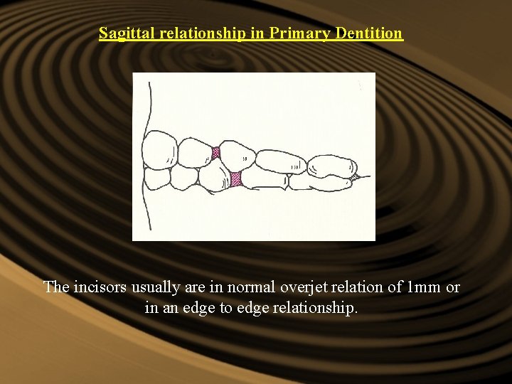 Sagittal relationship in Primary Dentition The incisors usually are in normal overjet relation of Sagittal relationship in Primary Dentition The incisors usually are in normal overjet relation of
