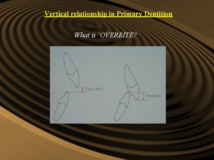 Vertical relationship in Primary Dentition What is ‘OVERBITE? Vertical relationship in Primary Dentition What is ‘OVERBITE?