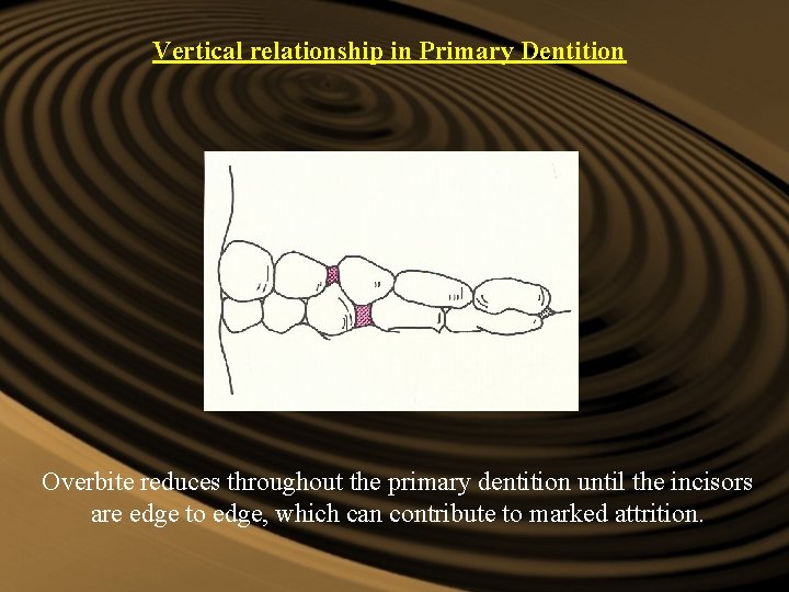 Vertical relationship in Primary Dentition Overbite reduces throughout the primary dentition until the incisors Vertical relationship in Primary Dentition Overbite reduces throughout the primary dentition until the incisors