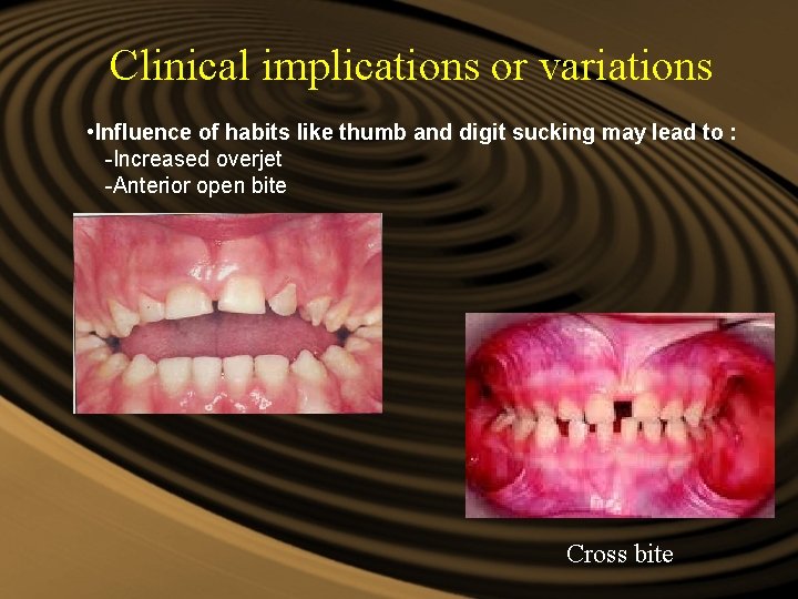Clinical implications or variations • Influence of habits like thumb and digit sucking may Clinical implications or variations • Influence of habits like thumb and digit sucking may