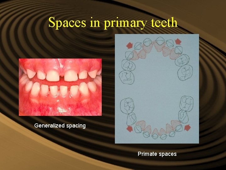 Spaces in primary teeth Generalized spacing Primate spaces Spaces in primary teeth Generalized spacing Primate spaces