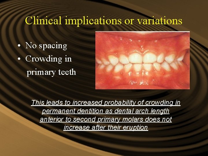 Clinical implications or variations • No spacing • Crowding in primary teeth This leads Clinical implications or variations • No spacing • Crowding in primary teeth This leads