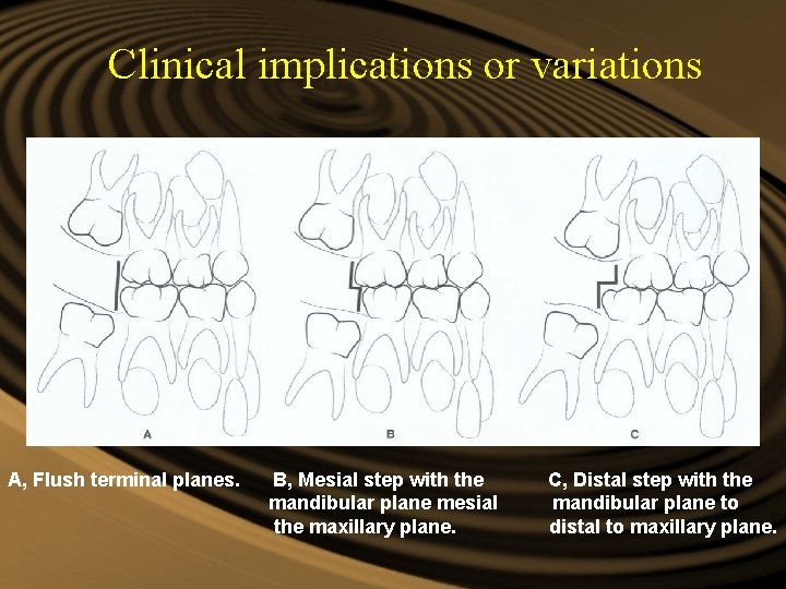Clinical implications or variations A, Flush terminal planes. B, Mesial step with the mandibular Clinical implications or variations A, Flush terminal planes. B, Mesial step with the mandibular