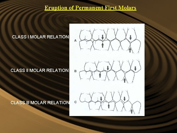 Eruption of Permanent First Molars CLASS l MOLAR RELATION CLASS lll MOLAR RELATION Eruption of Permanent First Molars CLASS l MOLAR RELATION CLASS lll MOLAR RELATION