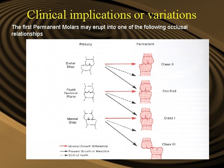 Clinical implications or variations The first Permanent Molars may erupt into one of the Clinical implications or variations The first Permanent Molars may erupt into one of the