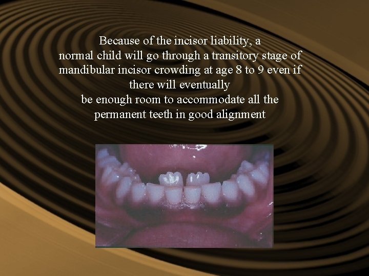 Because of the incisor liability, a normal child will go through a transitory stage Because of the incisor liability, a normal child will go through a transitory stage