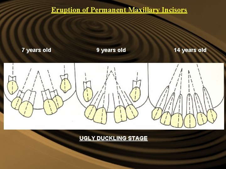 Eruption of Permanent Maxillary Incisors 7 years old 9 years old UGLY DUCKLING STAGE Eruption of Permanent Maxillary Incisors 7 years old 9 years old UGLY DUCKLING STAGE