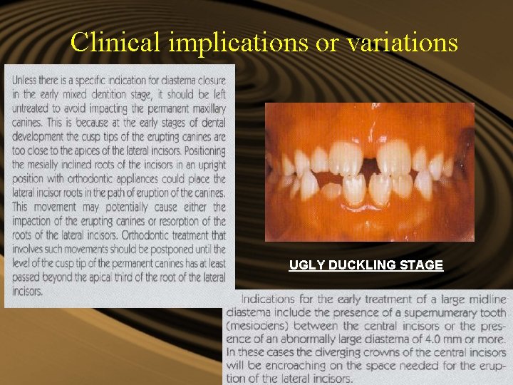 Clinical implications or variations UGLY DUCKLING STAGE Clinical implications or variations UGLY DUCKLING STAGE