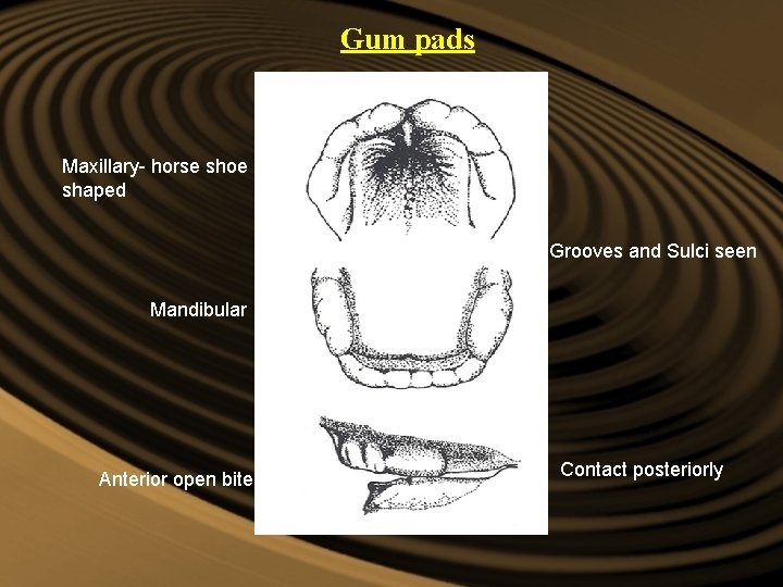 Gum pads They are pink, firm and fibrous Maxillary- horse shoe shaped Grooves and Gum pads They are pink, firm and fibrous Maxillary- horse shoe shaped Grooves and