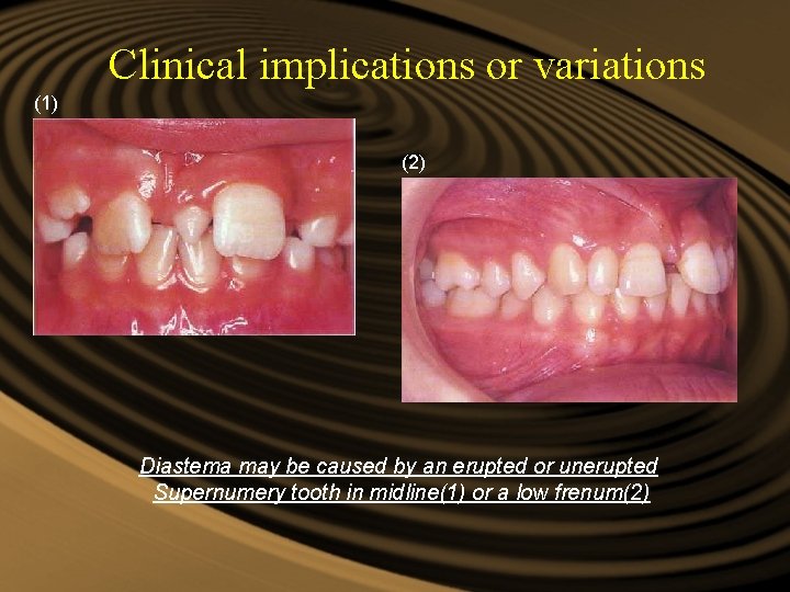 Clinical implications or variations (1) (2) Diastema may be caused by an erupted or Clinical implications or variations (1) (2) Diastema may be caused by an erupted or