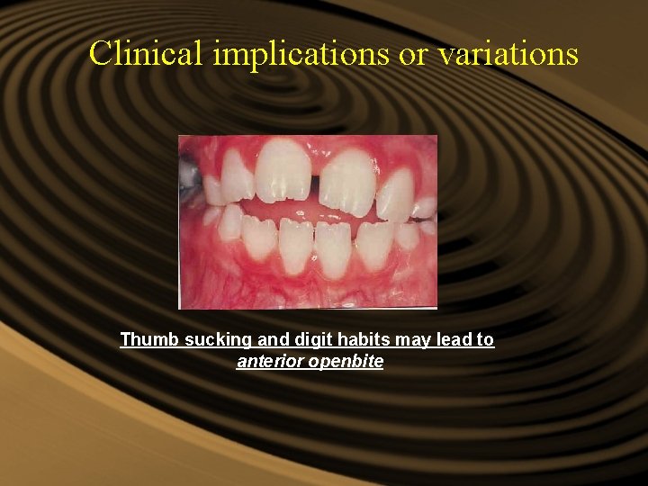 Clinical implications or variations Thumb sucking and digit habits may lead to anterior openbite Clinical implications or variations Thumb sucking and digit habits may lead to anterior openbite