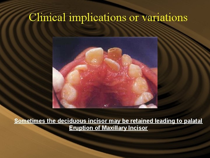 Clinical implications or variations Sometimes the deciduous incisor may be retained leading to palatal Clinical implications or variations Sometimes the deciduous incisor may be retained leading to palatal