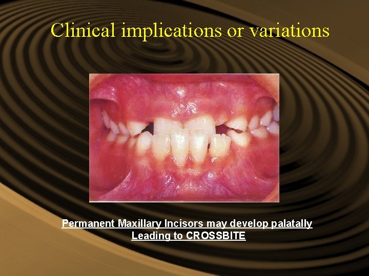 Clinical implications or variations Permanent Maxillary Incisors may develop palatally Leading to CROSSBITE Clinical implications or variations Permanent Maxillary Incisors may develop palatally Leading to CROSSBITE