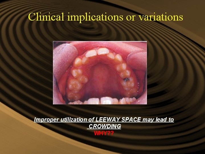 Clinical implications or variations Improper utilization of LEEWAY SPACE may lead to CROWDING WHY? Clinical implications or variations Improper utilization of LEEWAY SPACE may lead to CROWDING WHY?