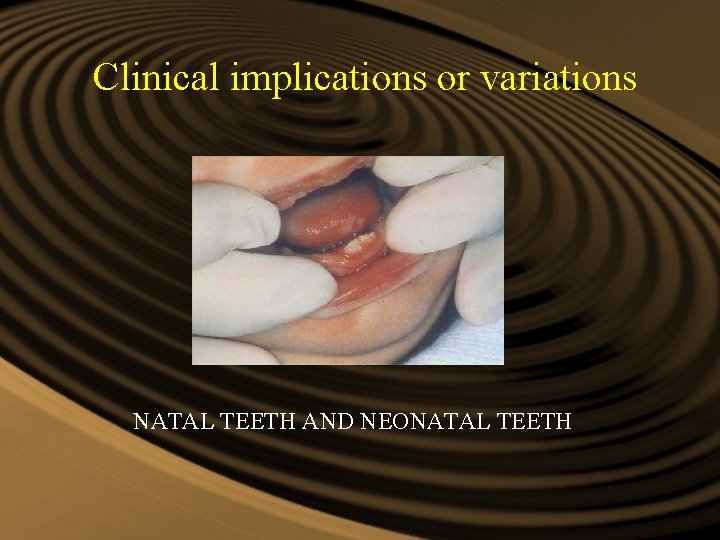 Clinical implications or variations NATAL TEETH AND NEONATAL TEETH Clinical implications or variations NATAL TEETH AND NEONATAL TEETH