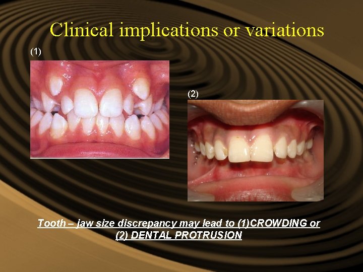 Clinical implications or variations (1) (2) Tooth – jaw size discrepancy may lead to Clinical implications or variations (1) (2) Tooth – jaw size discrepancy may lead to