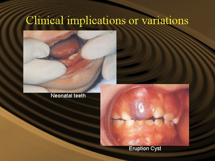 Clinical implications or variations Neonatal teeth Eruption Cyst Clinical implications or variations Neonatal teeth Eruption Cyst