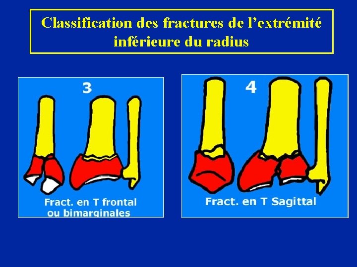 Classification des fractures de l’extrémité inférieure du radius 
