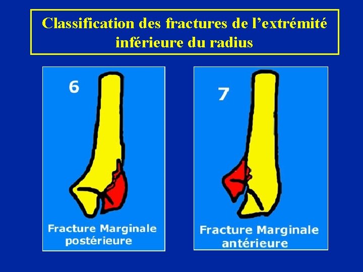 Classification des fractures de l’extrémité inférieure du radius 