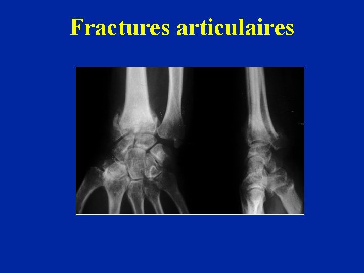 Fractures articulaires 