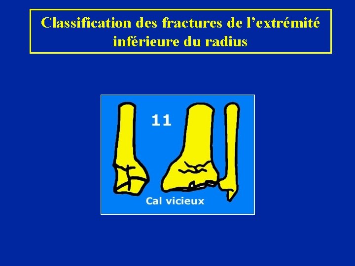 Classification des fractures de l’extrémité inférieure du radius 