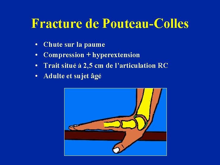 Fracture de Pouteau-Colles • • Chute sur la paume Compression + hyperextension Trait situé
