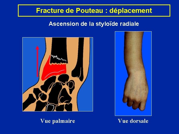 Fracture de Pouteau : déplacement Ascension de la styloïde radiale Vue palmaire Vue dorsale