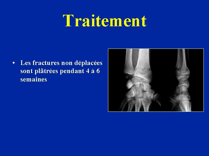 Traitement • Les fractures non déplacées sont plâtrées pendant 4 à 6 semaines 