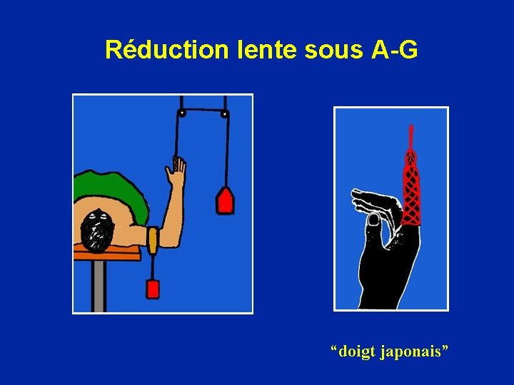 Réduction lente sous A-G “doigt japonais” 