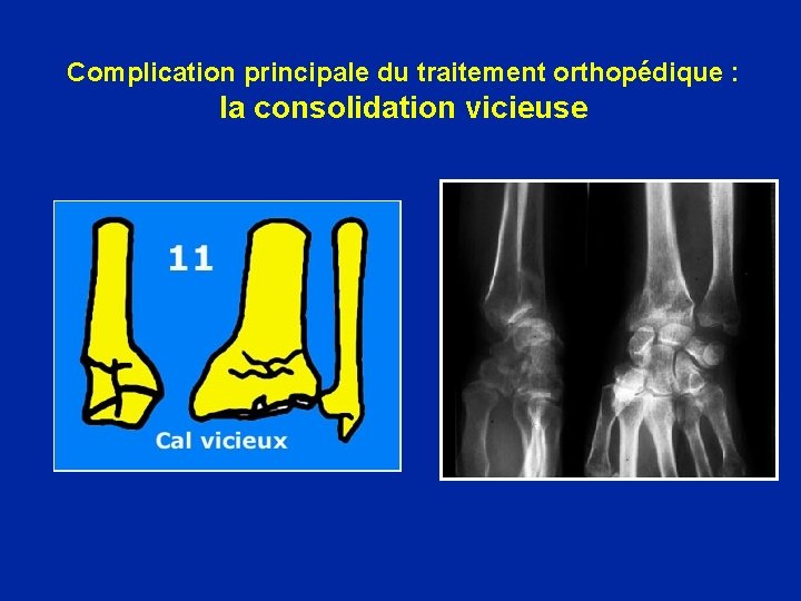 Complication principale du traitement orthopédique : la consolidation vicieuse 