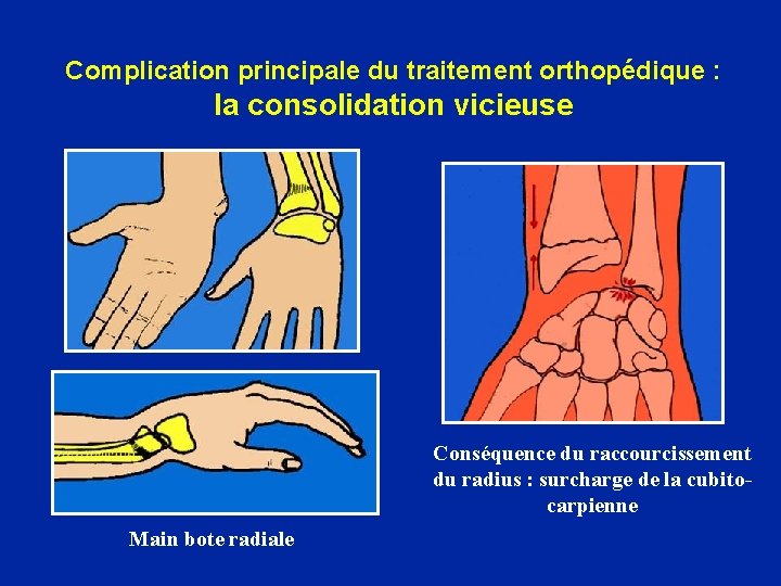 Complication principale du traitement orthopédique : la consolidation vicieuse Conséquence du raccourcissement du radius