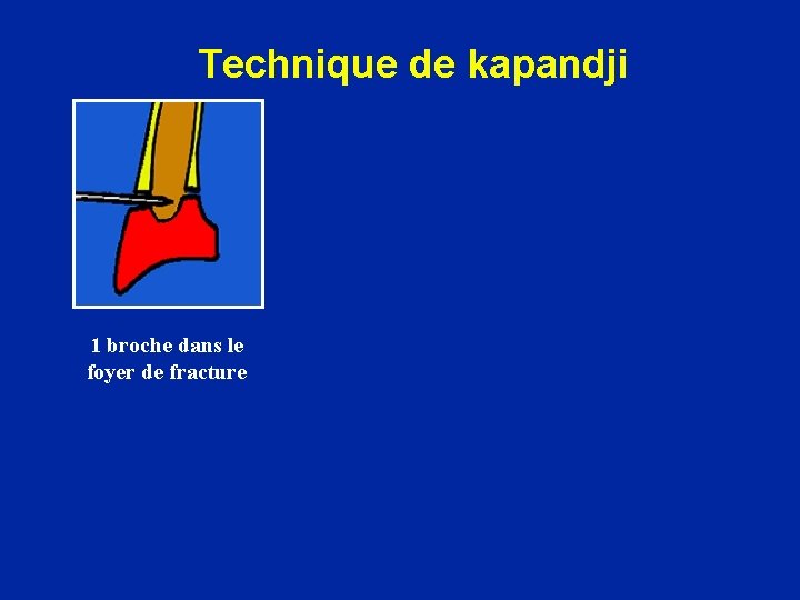 Technique de kapandji 1 broche dans le foyer de fracture 